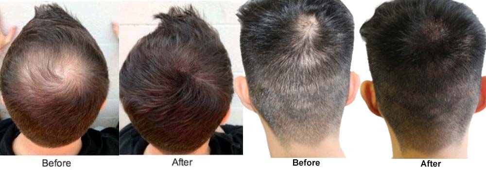 beforeafter