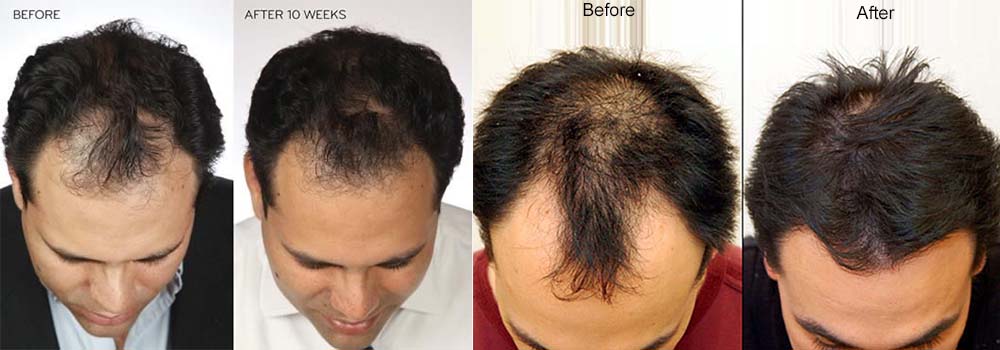 beforeafter