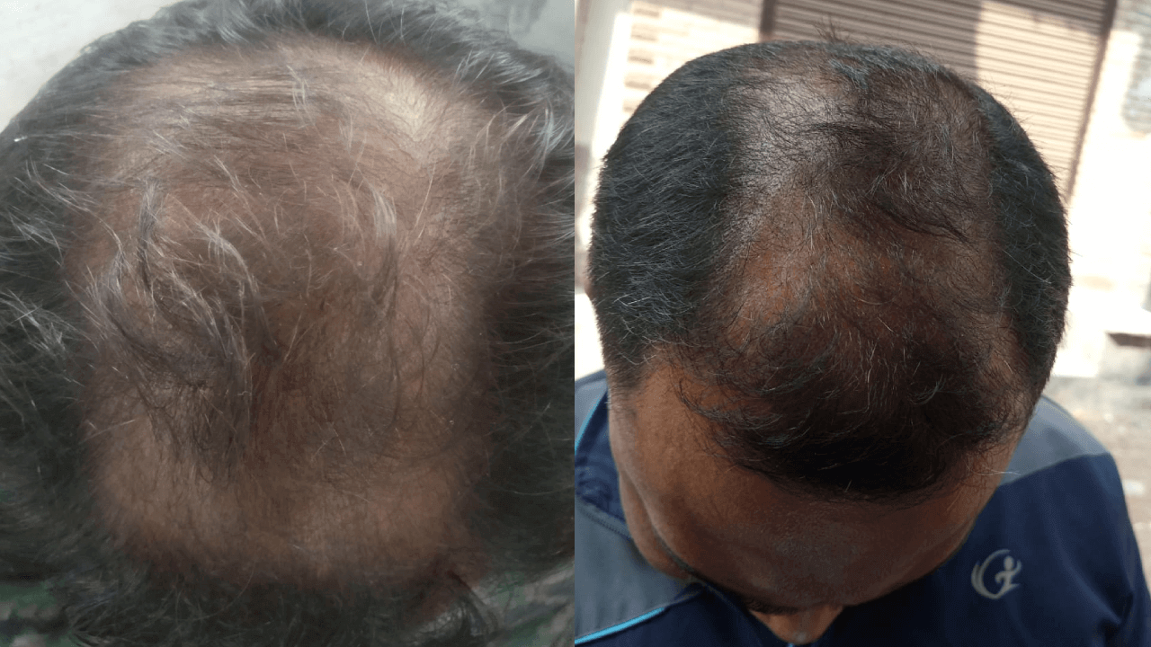 Hair loss